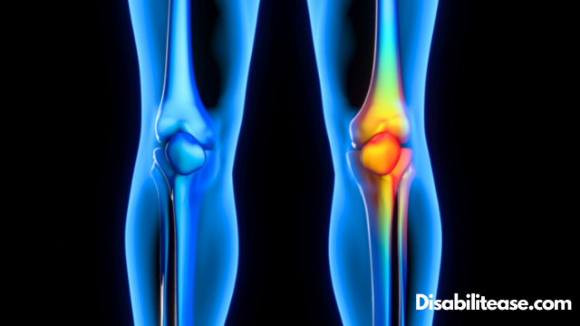 Arthritis Causes Bone Spurs