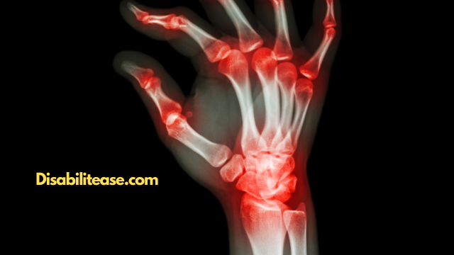 Non-Erosive Arthritis