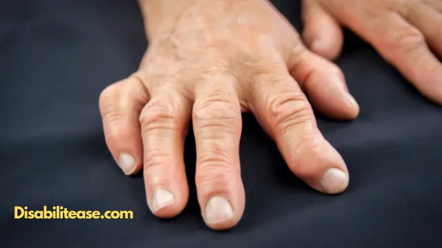 Rheumatoid Arthritis 